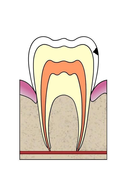 hull i tann 2