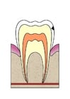 bilder hull i tann 2