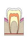 bilde hull i tann 1