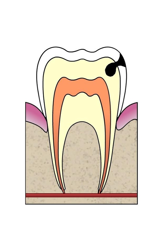 bilde hull i tann 3