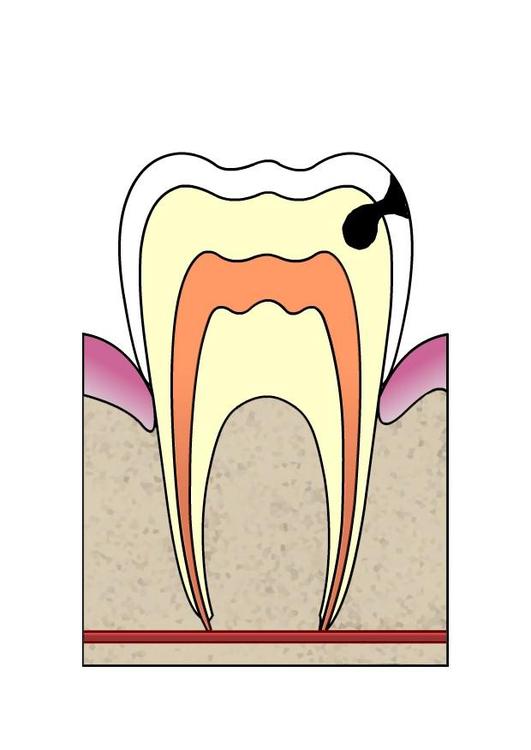 hull i tann 3