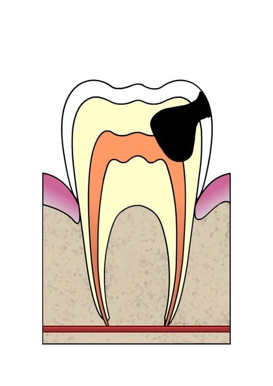 bilde hull i tann 4