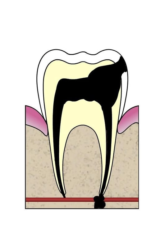 bilde hull i tann 5