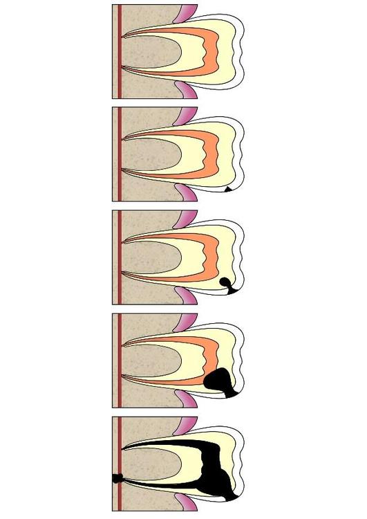 tannhull